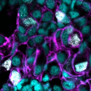 Research reveals genetic weak spot in hard-to-treat cancers