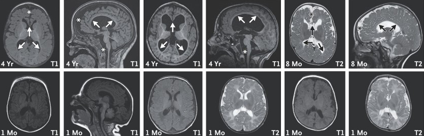 Magnetic resonance imaging (MRI) scans of the brain in three children with a missing copy of the Chaserr gene. The scans performed at age 8 months or 4 years (top row) reveal structural changes in the brain, including reduced volume of the brain stem (asterisks) and decreased myelin coating of nerves (arrows) in deep-seated brain areas. These changes are less apparent at 1 month of age (bottom row)