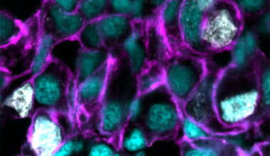 Research reveals genetic weak spot in hard-to-treat cancers