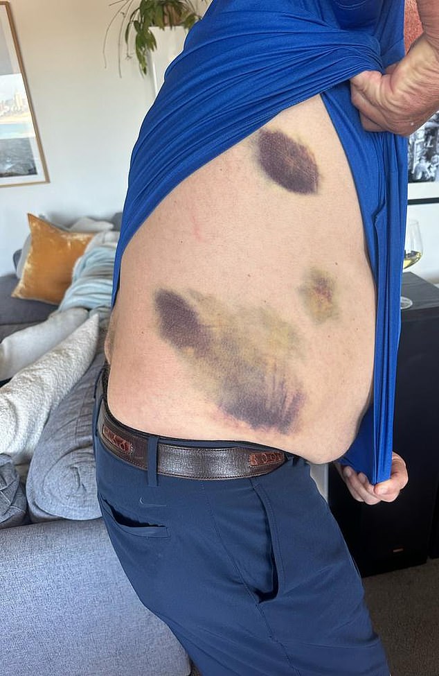 'Beefy' was pulled out of the water while 'quite a few' of the deadly reptiles looked on - and he was left with severe bruising afterwards (pictured)