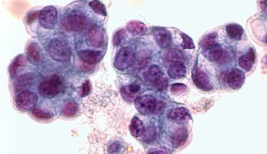 Lipid droplet protein perilipin 2 linked to poor prognosis in lung cancer
