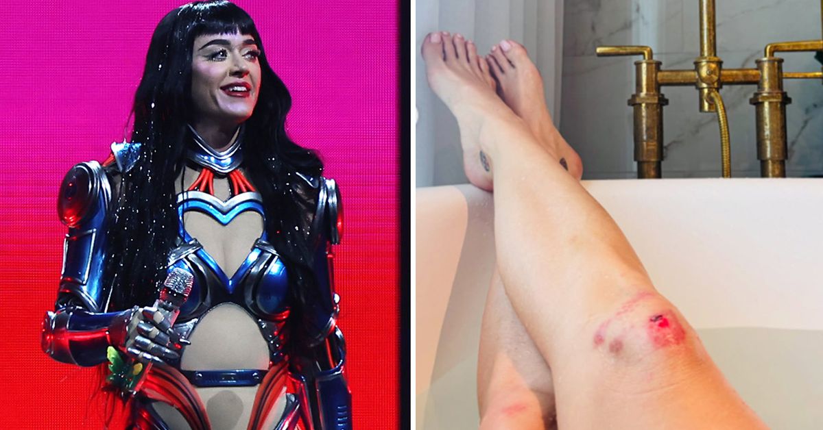 Katy Perry posts knee injury photo after faceplant on stage during Lifetimes Tour show