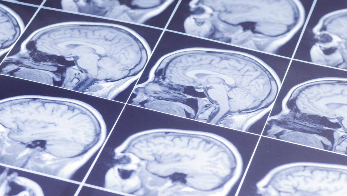 Man With 31-Year History Of Depression Feels “Overwhelming Joy” After Experimental Brain Stimulation