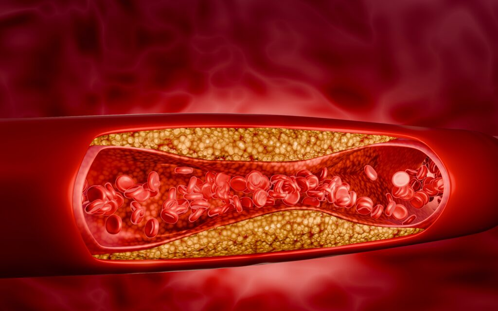 The need to urgently rethink coronary heart disease - Featured Image