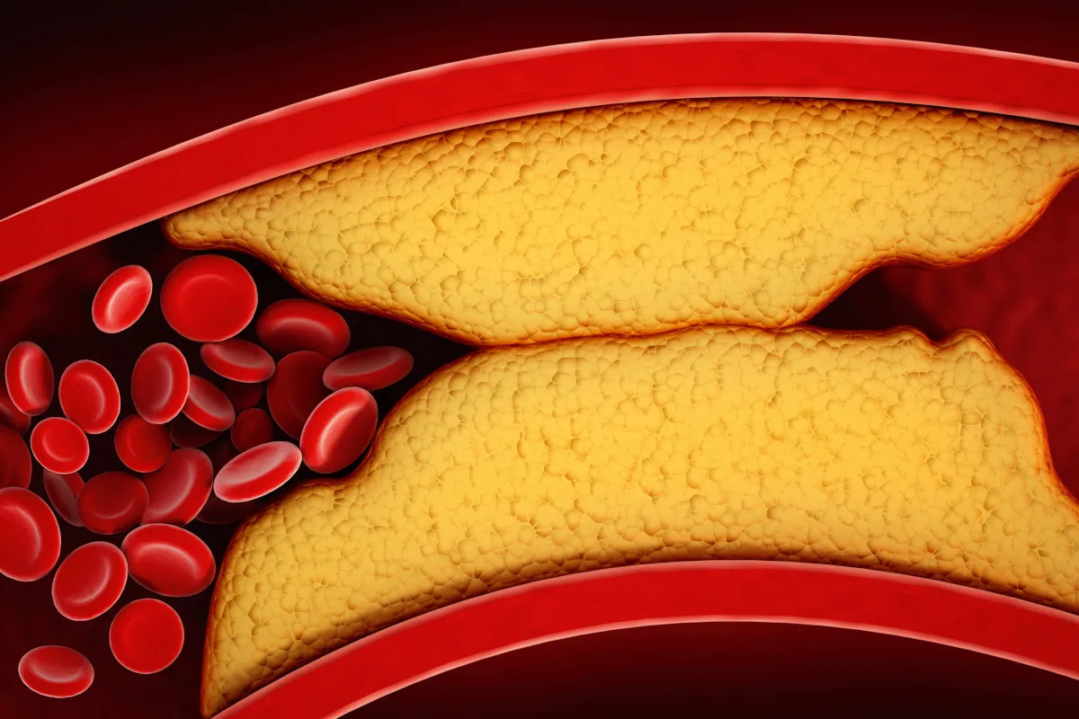 3D visualization of thickened arteries and veins, coronary heart disease