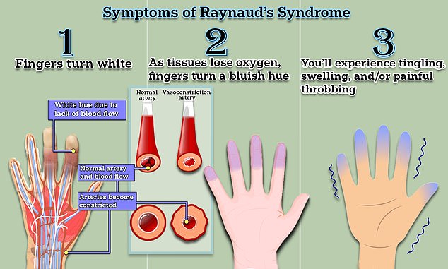 It is the body’s response to cold temperatures in which smaller arteries that supply blood to the skin constrict dramatically and limit blood supply to certain areas of the body - most commonly the fingers, but sometimes also the toes, ears, and tip of the nose