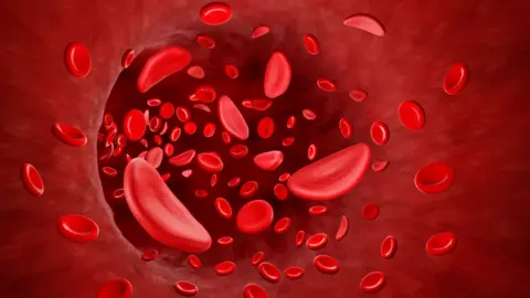 Getty Images An illustration of red blood cells travelling through a blood vessel in a person with sickle cell disease. The red blood cells are shaped like sickles or crescents, and there are dozens of them moving through a red, fleshy tube.