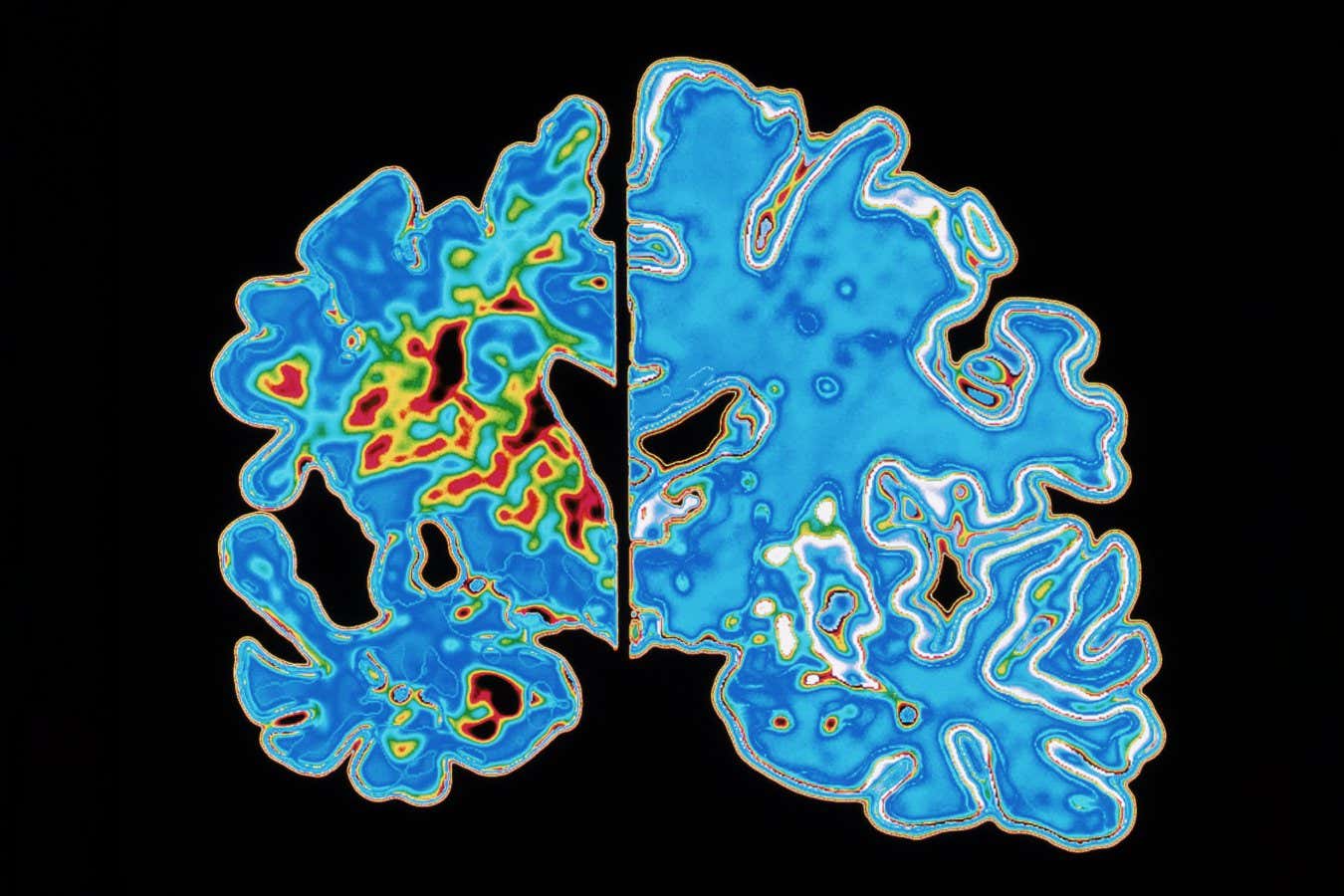 A comparison of brain tissue with and without Alzheimer's. This disease causes brain tissue to shrink