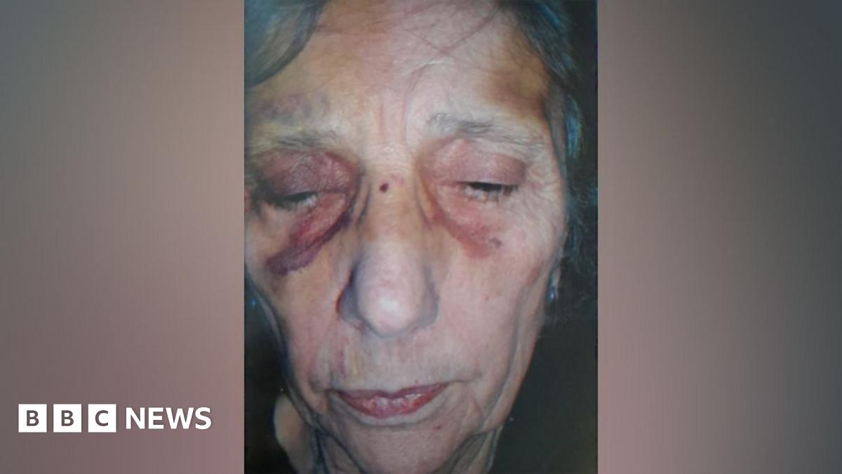 A close up of Iris Scott's face which has visible purple and yellow bruising on her temples and around her eye sockets.