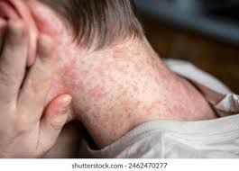 Measles alert issued for Sydney, airport