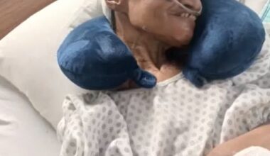 Edna Burton, 61, of Michigan, alleges hospital staff lost a chunk of her skull during surgery and attempted to compensate her with a $25 gas station gift card