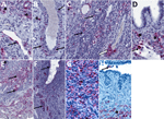 Detection of Lassa virus (LASV) antigens and RNA in reproductive tissues by immunohistochemistry (IHC) and in situ hybridization (ISH) in strain 13/N female guinea pigs lethally infected with LASV strain Josiah in study of guinea pig model for LASV infection of reproductive tract and considerations for sexual and vertical transmission. IHC and ISH chromogens are red. A) Uterus (25 dpi), ISH. Staining in interstitial mesenchymal cells (asterisks) and rare endothelial cells (arrow). B) Uterus (23 dpi), ISH. Staining in vascular smooth muscle cells (arrows) and perivascular interstitial mesenchymal cells (asterisk). C) Ovary (23 dpi), ISH. Staining within a corpus luteum (asterisk), in theca-interstitial cells (arrows), and in inflammatory cells within and around a vascular wall (white arrow). D) Oviduct (23 dpi), ISH. Staining in mesenchymal interstitial cells (asterisk) and intravascular inflammatory cells (arrow). E) Uterus (23 dpi), ISH. Extensive staining in the endometrial stroma (asterisk) and myometrial smooth muscle cells (arrows). F) Uterus (23 dpi), ISH. Extensive staining in the endometrial glandular epithelial cells (arrows). G) Endocervix (23 dpi), IHC. Extensive staining in mesenchymal cells. H) Vagina (23 dpi), IHC. Staining in submucosal mesenchymal cells (asterisk) and intraluminal cellular debris (arrow). Original magnifications ×40 (panels A, B, D, F, H), ×30 (panel C), ×20 (panels E, G). 