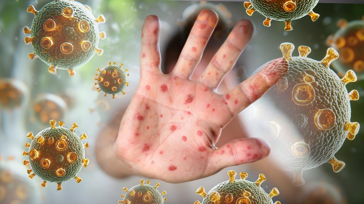 Health alert as traveller inflected with measles visits urgent care clinic in Perth’s south