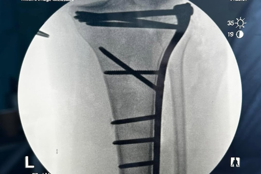 An x-ray of Sarah Larcombe's leg showing pins and plates in her tibia near her knee.