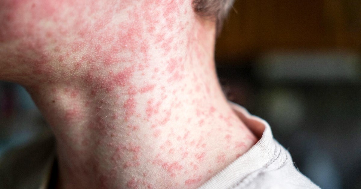 N.J. health officials warn of potential measles exposures at Newark Liberty Airport. Here's what we know.