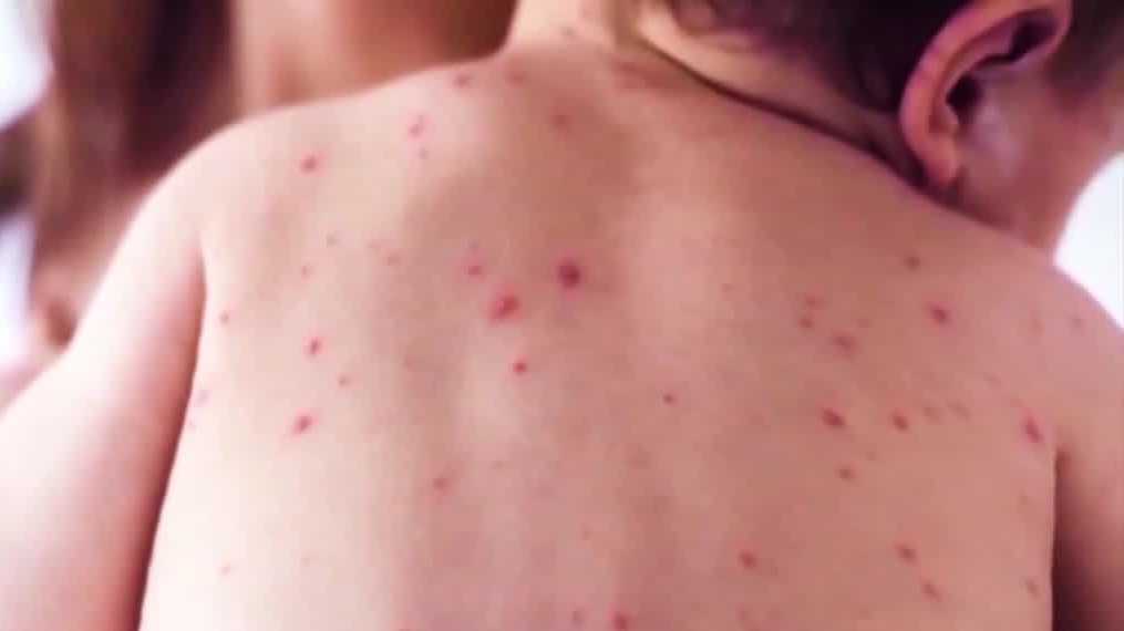 20 new measles cases reported in South Carolina since Friday