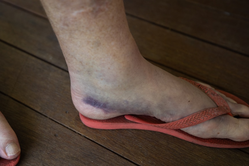 Photo of bruising on a person's thong-wearing foot