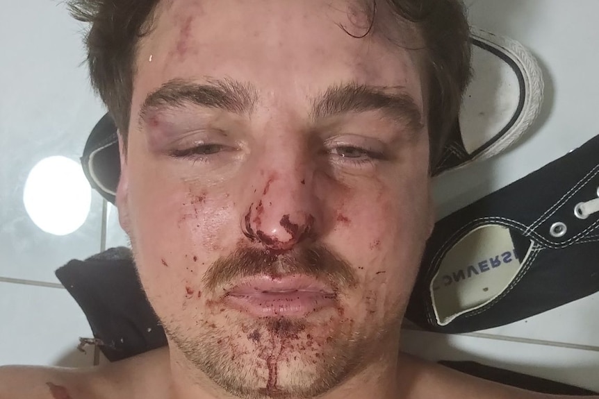 A man's face is bruised and battered. He lies on a tiled floor on top of a pair of shoes with blood on his chest