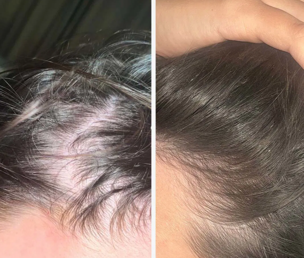 A before and after using Dr Vegan's Hair Saviour tablets with thinning hair on the left and a fuller head of hair on the right