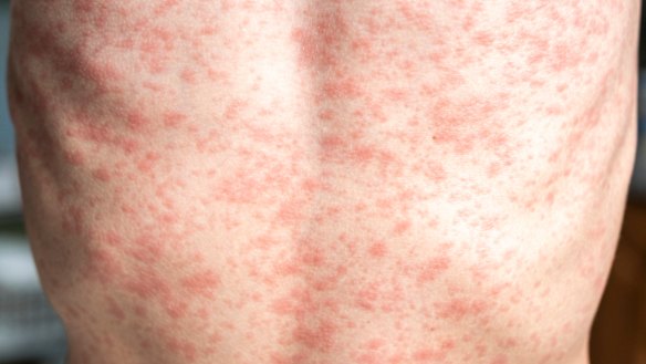 Measles is often characterised by a rash that spreads across the body.