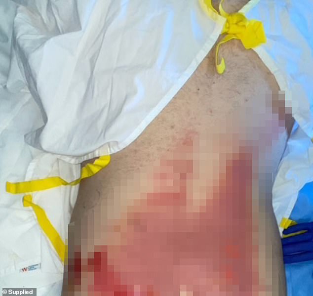 Reece woke up in flames after his power bank exploded