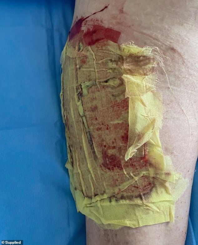 Reece underwent surgeries and multiple skin grafts after his power bank exploded