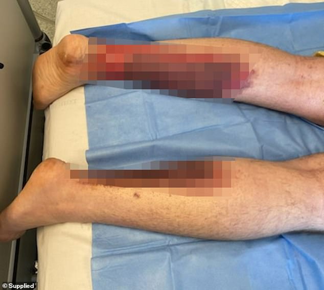 He spent two weeks in hospital recovering from serious burns caused by a power bank