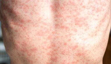 Health alert issued after 11 cases in three weeks