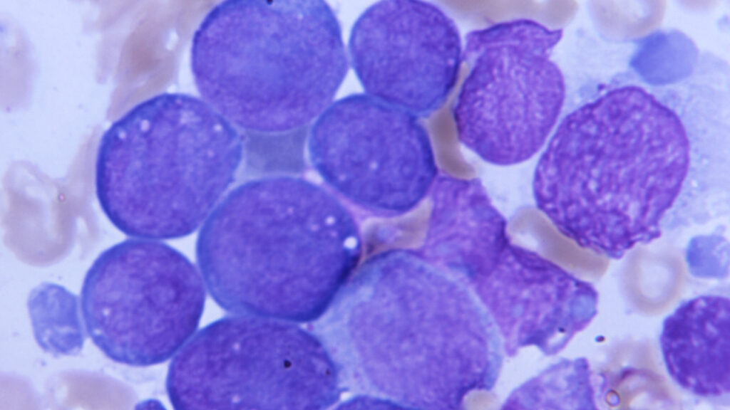 Genetic variant appears to protect against blood cancers