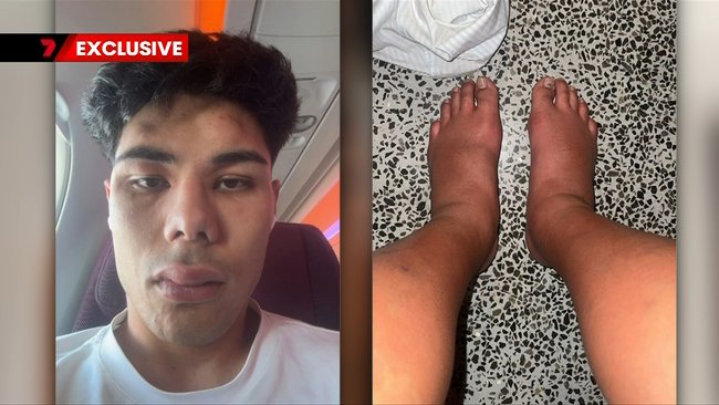 Curtis reacted to his antibiotics while flying from London to Bali.