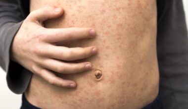 Measles exposure sites in WA: Fiona Stanley Hospital emergency department visited by infected person