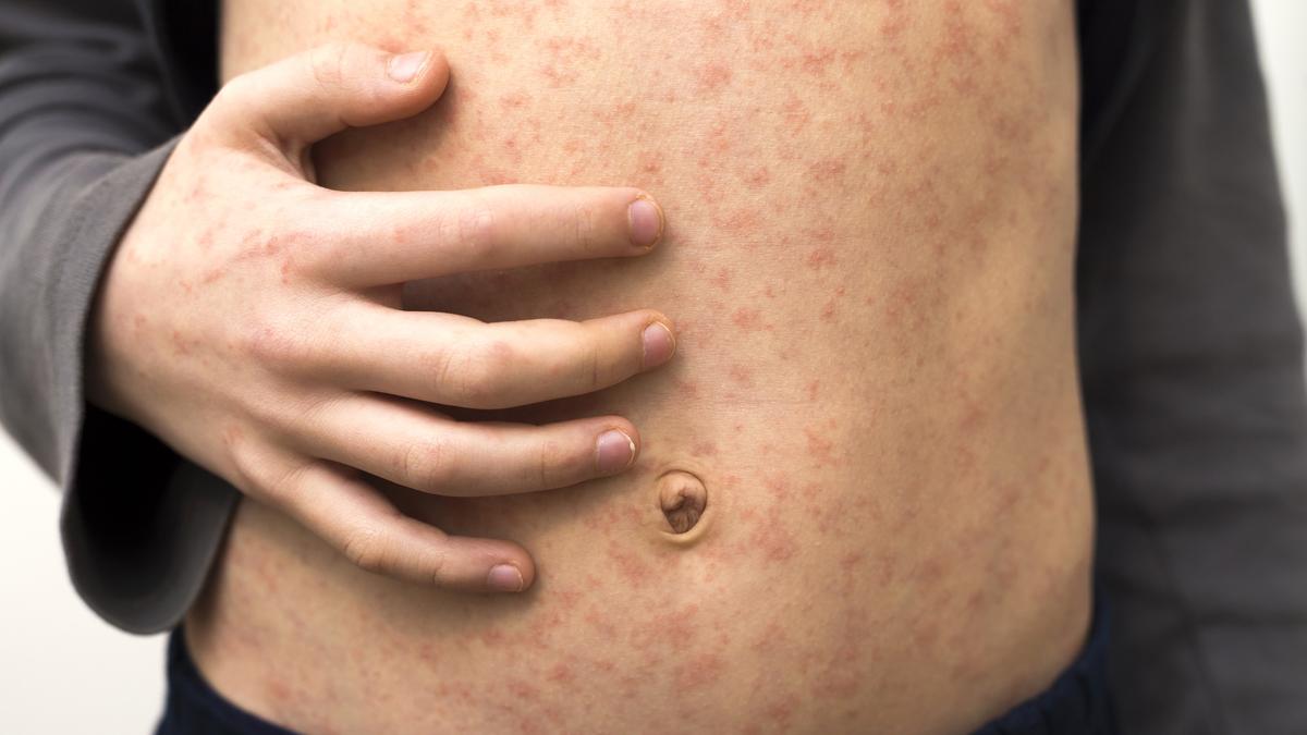 Measles exposure sites in WA: Fiona Stanley Hospital emergency department visited by infected person
