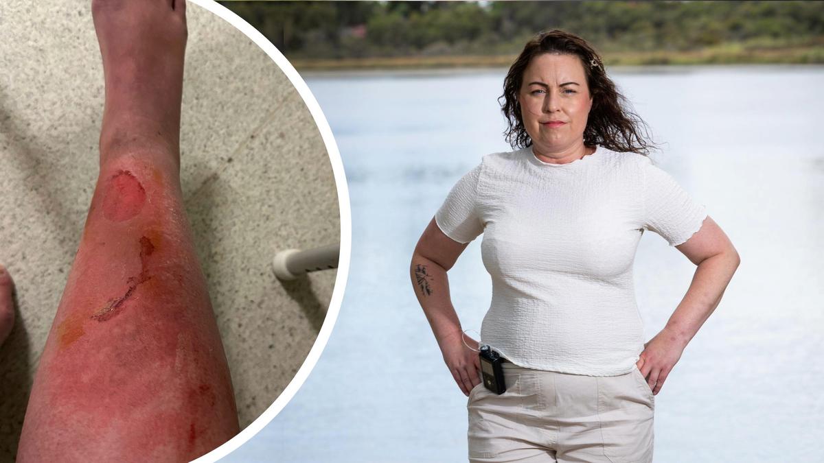 Perth mum Andrea Bowden warning others after jellyfish sting at Peppermint Grove Beach nearly cost her a leg