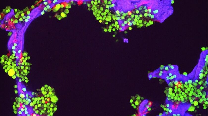 Why are men more likely to develop multiple myeloma than women?