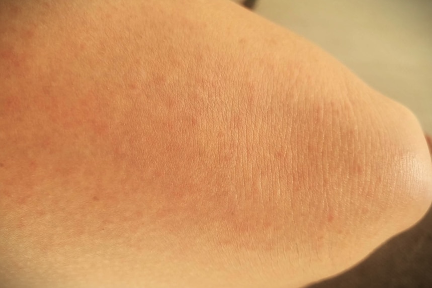 a red skin rash.