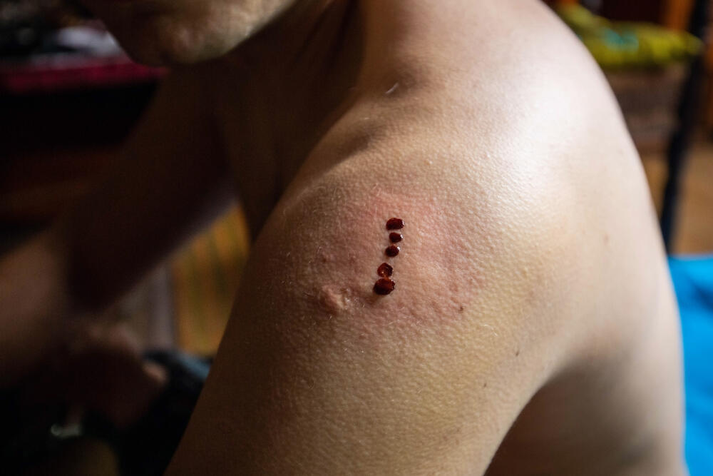 The burn marks left on the skin after the ritual (Photo: Shutterstock) הצריבות שנשארות על העור לאחר הטקס