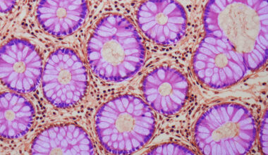 A Hidden Warning Sign Discovered in The Gut May Increase Cancer Risk : ScienceAlert