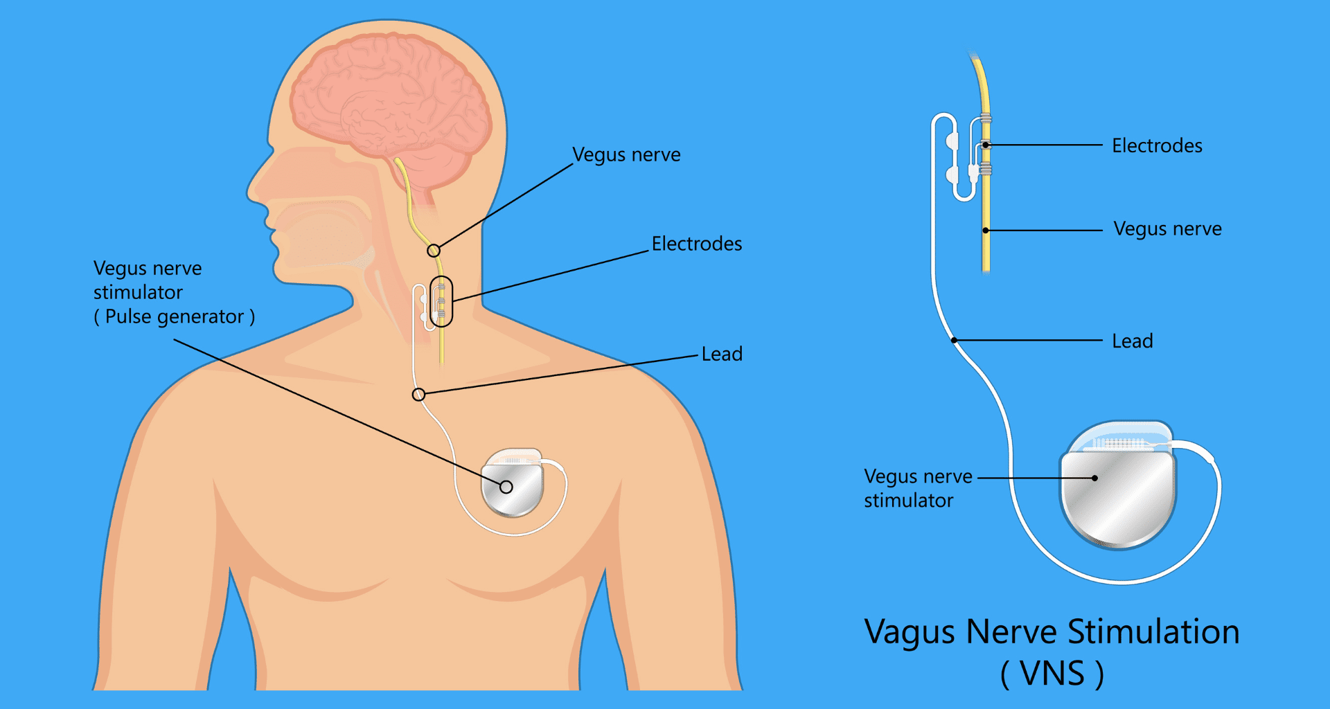 Vagus Nerve Stimulation