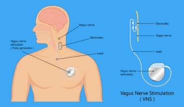 Vagus Nerve Stimulation