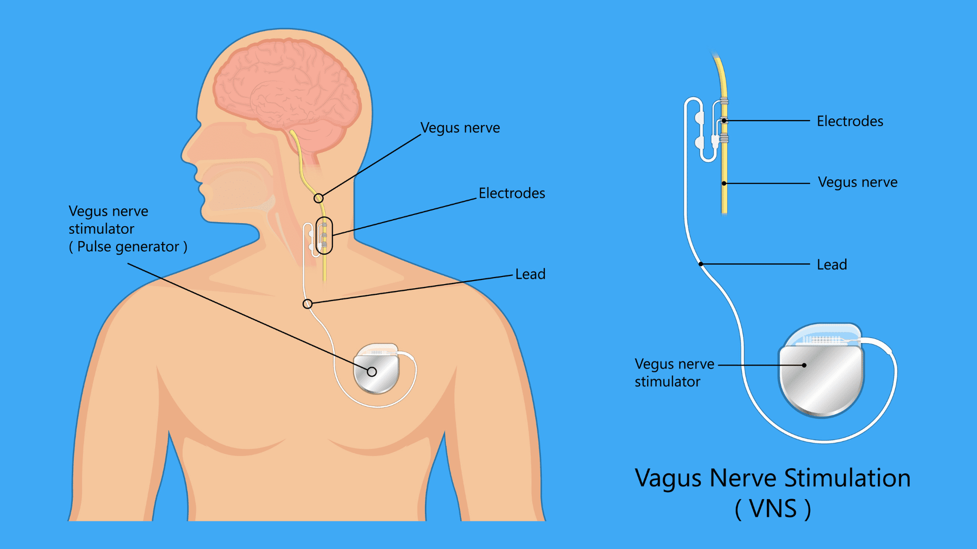 Vagus Nerve Stimulation
