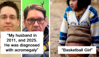 57 Fascinating Medical Cases That Might Leave You Amazed, Curious, And Slightly Nauseous