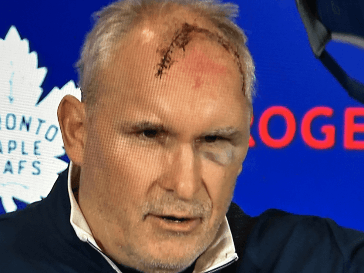 Leafs coach Craig Berube suffers large cut to head, bruised eye in gym accident