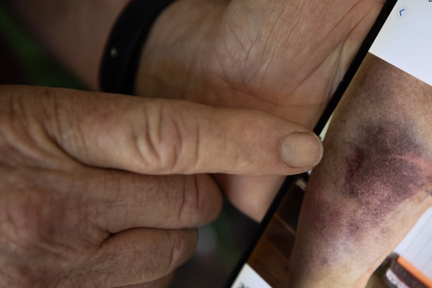 A photo of a man's hand pointing to a photo of bruising on a leg