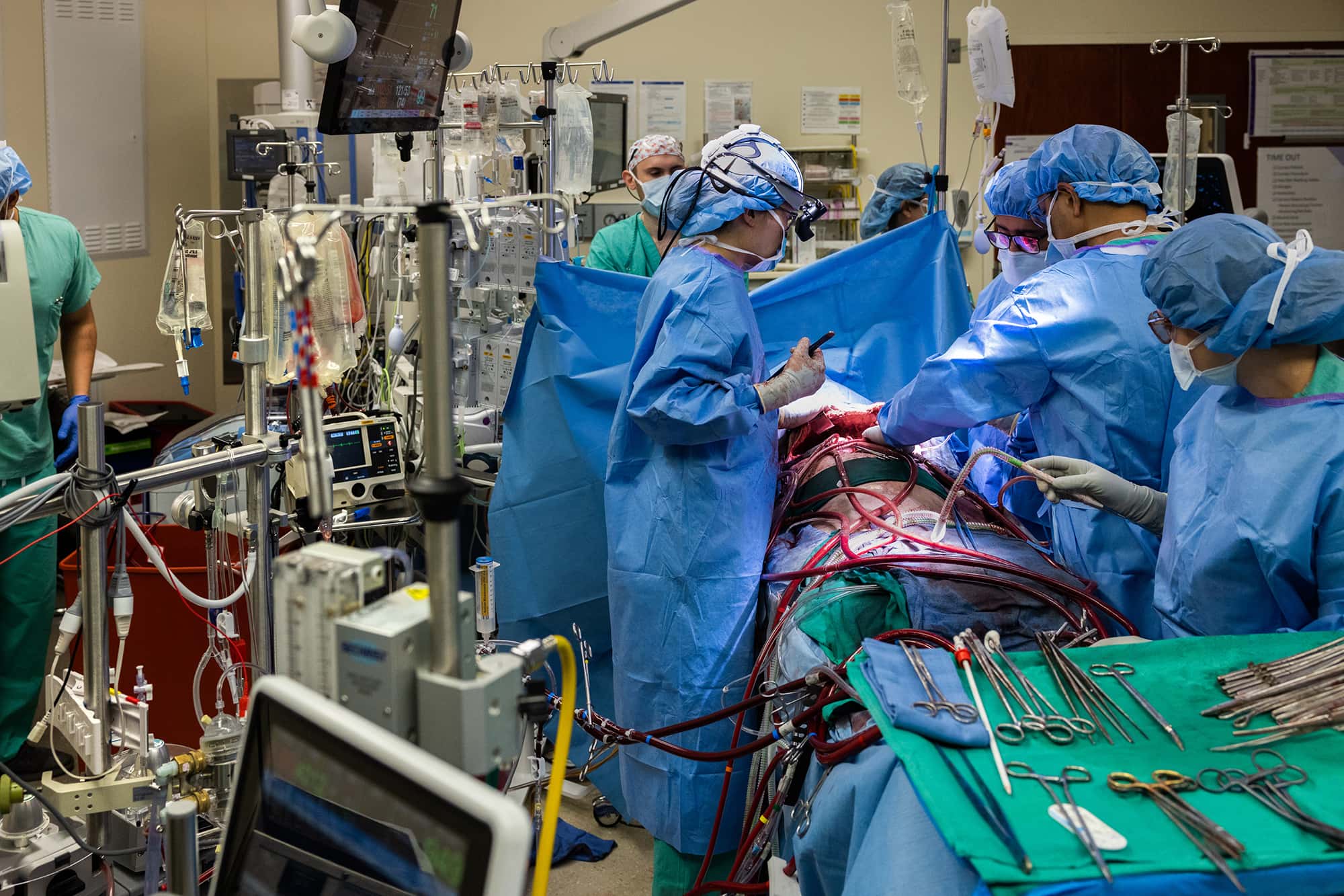 total artificial lung system during double-lung transplant