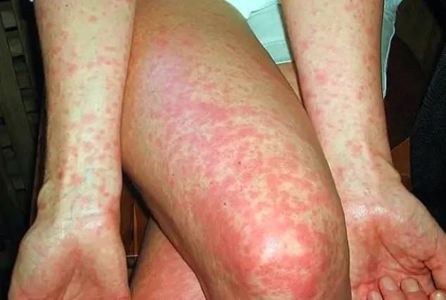 Sometimes symptoms may be accompanied by the appearance of a spotty red-purple rash