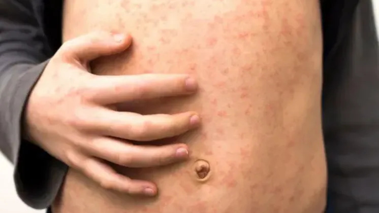 A close up of a stomach of a child that has the red measles rash. He is holding his stomach with one hand.
