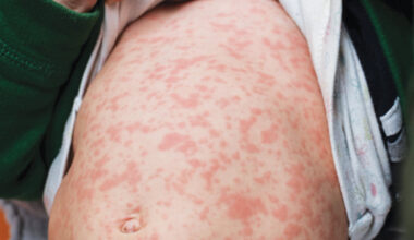 Measles alert expands to western NSW