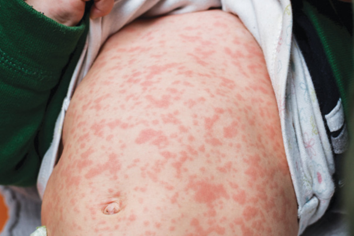 Measles alert expands to western NSW