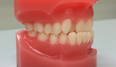 Underbite Is Associated With Tooth Loss Risk