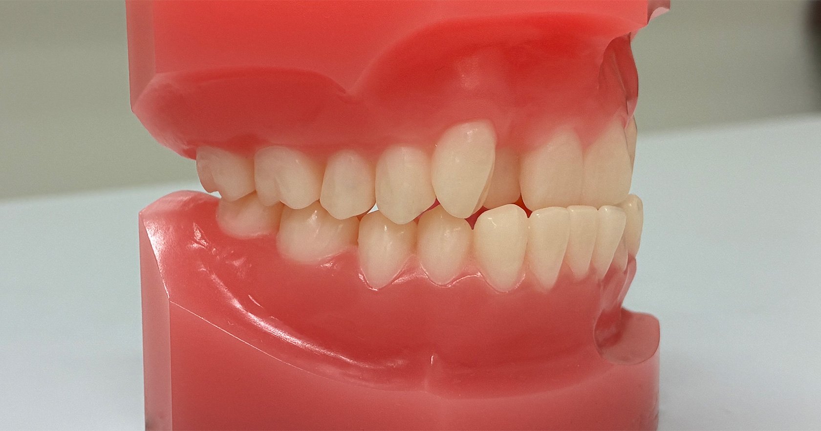 Underbite Is Associated With Tooth Loss Risk